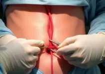ligadura elástica de varizes esofágicas